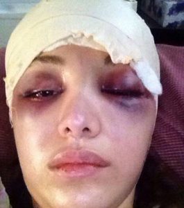 کبودی شدید صورت روشنک گرامی