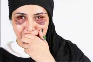 کبودی شدید صورت باران کوثری