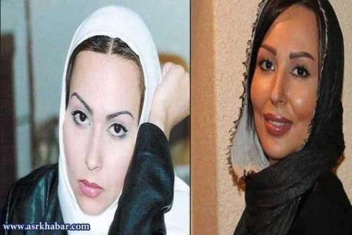 پرستو صالحی قبل از عمل بینی با شال سفید و پرستو صالحی بعد از عمل بینی با شال مشکی