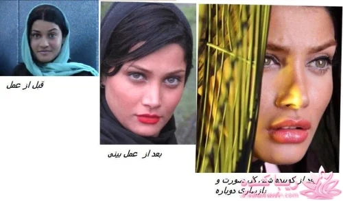 بینی تینا آخوندتبار قبل از عمل زیبایی