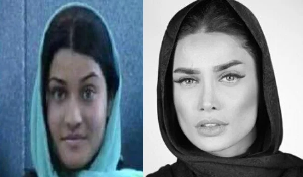 تینا آخوند تبار بعد از عمل بینی و قبل از عمل بینی - عمل زیبایی تینا آخوندتبار
