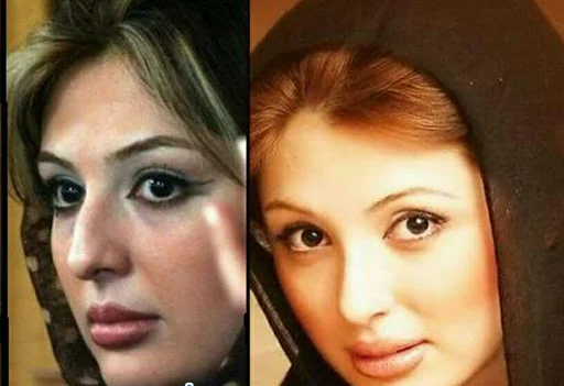 نیوشا ضیغمی قبل از عمل - عمل زیبایی نیوشا ضیغمی